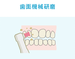 歯面機械研磨