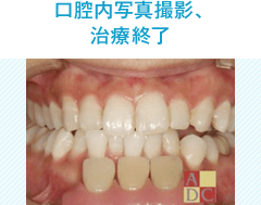 歯面機械研磨